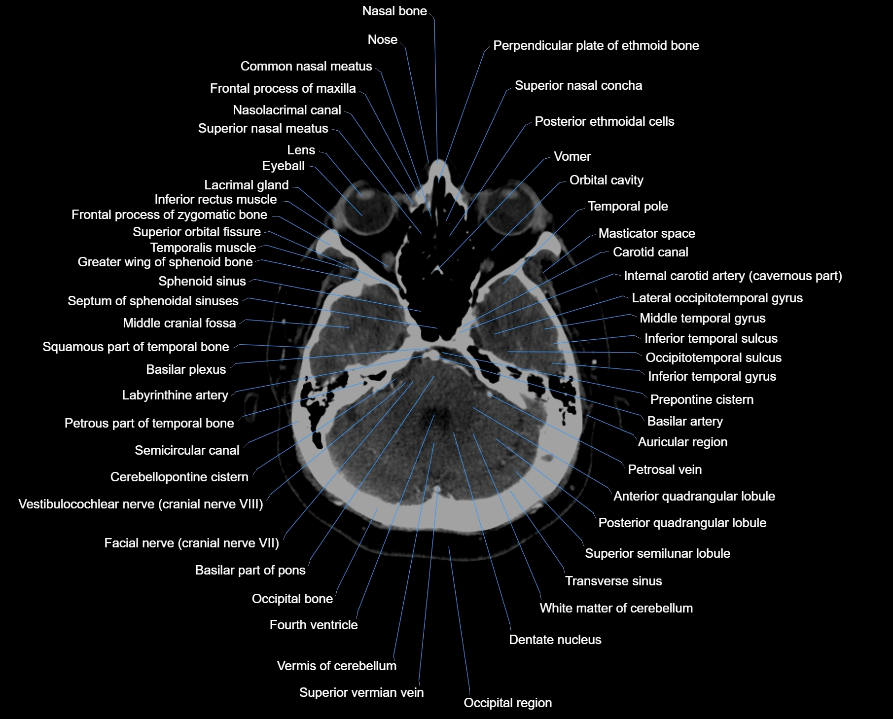 CT scan brain axial labelled cross sectional anatomy image-img-000019.webp